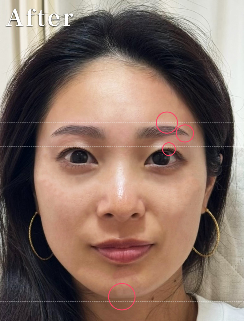 歪眉 施術後